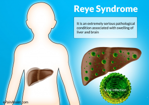 Reye syndrome for flu