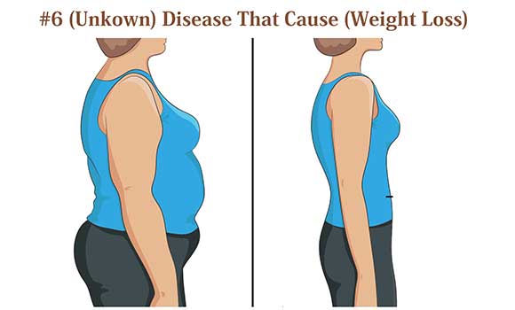 6 disease that causes weight loss - Fitness Health Forever