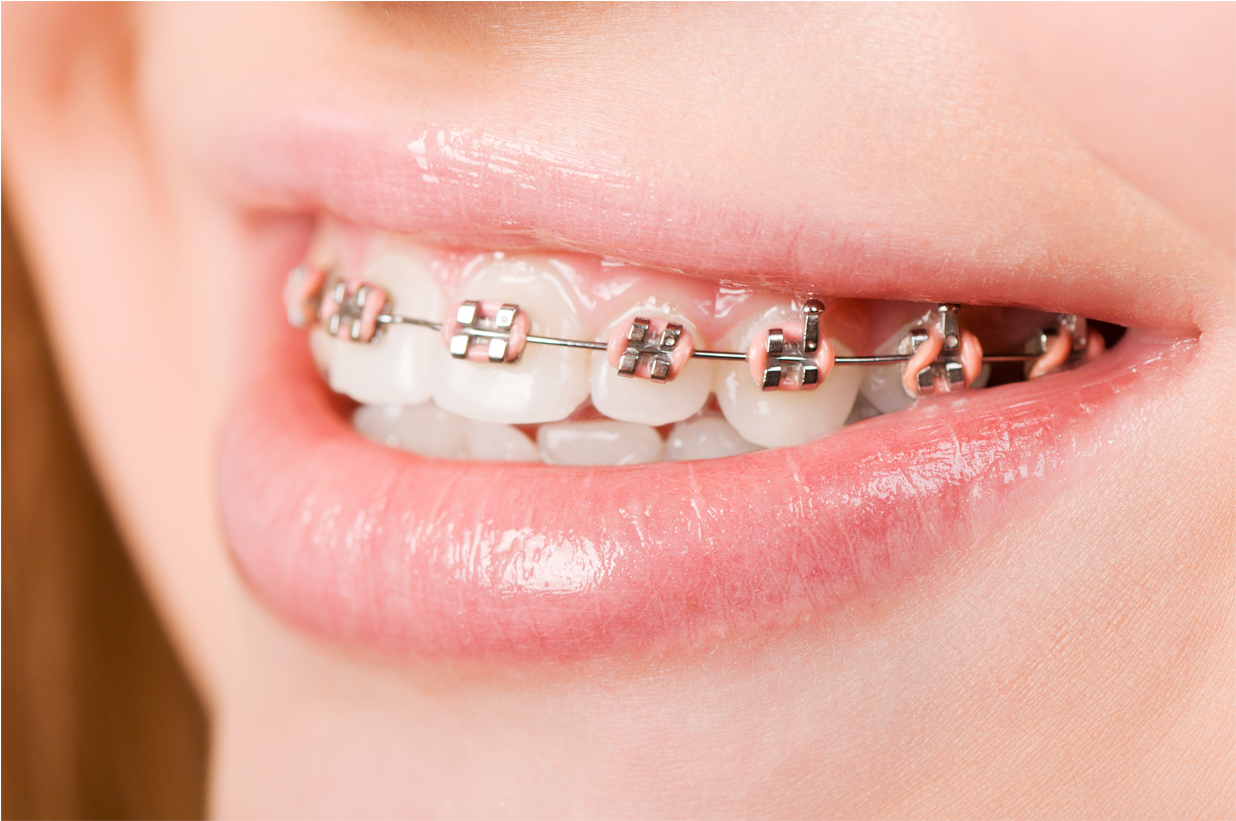 A Guide to Permanent Retainers after Braces From Orthodontist