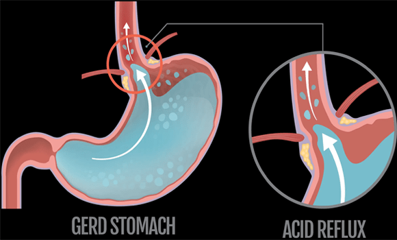 Foods that help acid reflux - Fitness health forever