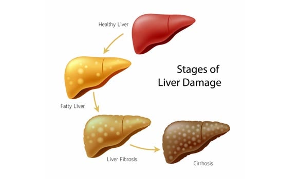 Liver damage symptoms-10 Common symptoms of liver damage - Health