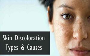 Skin Discoloration – Types, Causes, Treatment, & Much More - Health