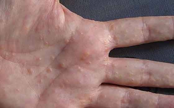 Dyshidrotic-Eczema