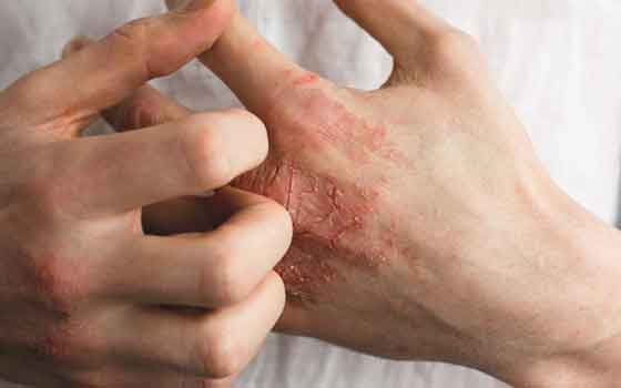 Hand Eczema