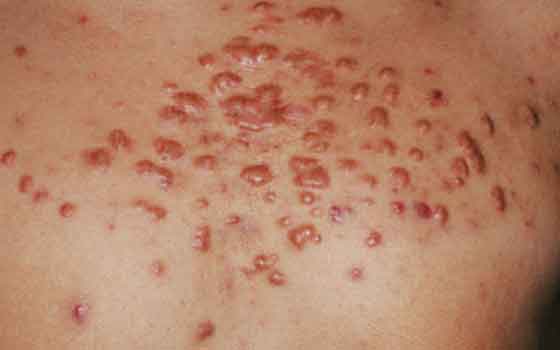Neurodermatitis