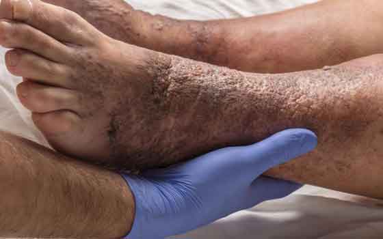 Stasis-Dermatitis